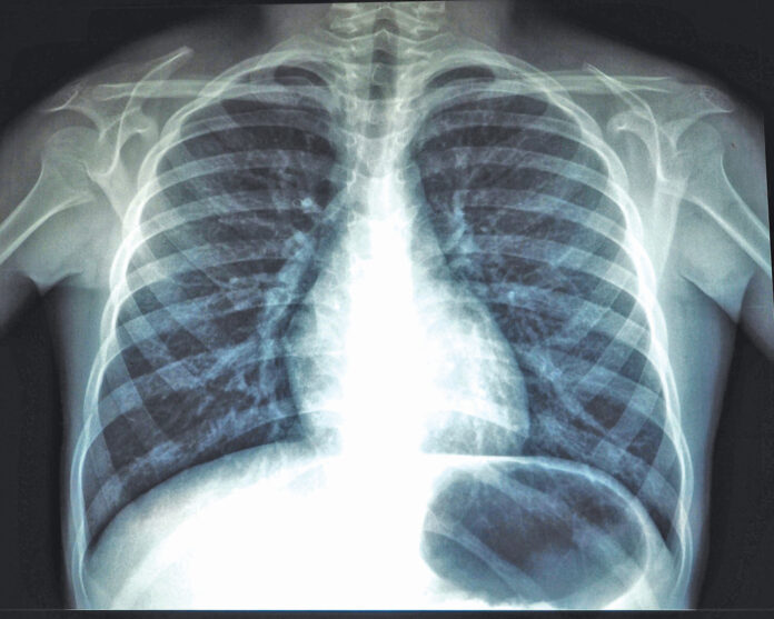 placa de rayos x de paciente con cáncer pulmonar